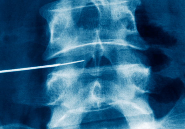  ô߼(Vertebroplasty)/  ôıǳ(Kyphoplasty)